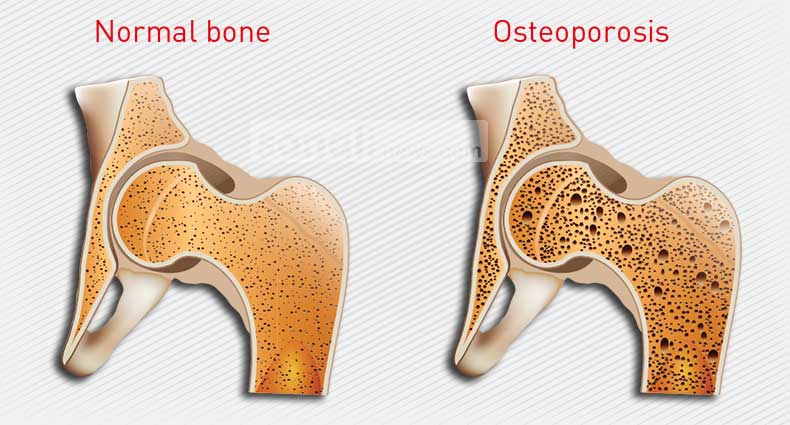 হাঁড়ের ক্ষয়রোগের কারণ ও চিকিৎসা