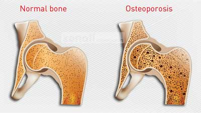 হাঁড়ের ক্ষয়রোগের কারণ ও চিকিৎসা