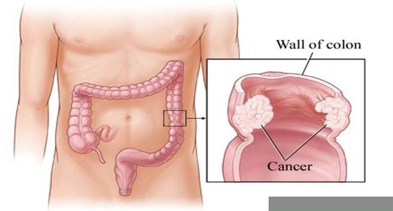 পায়খানার সঙ্গে রক্ত! কোলন ক্যানসার না তো!