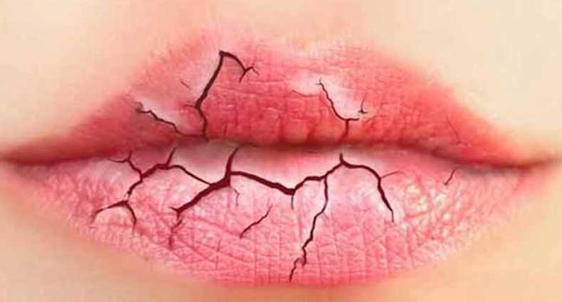 যেসব কারণে ঠোঁট শুষ্ক হয়