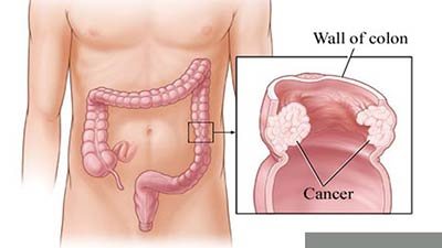 পায়খানার সঙ্গে রক্ত! কোলন ক্যানসার না তো!