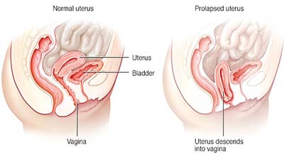 জরায়ুর স্থানচ্যুতির লক্ষণ ও করণীয়