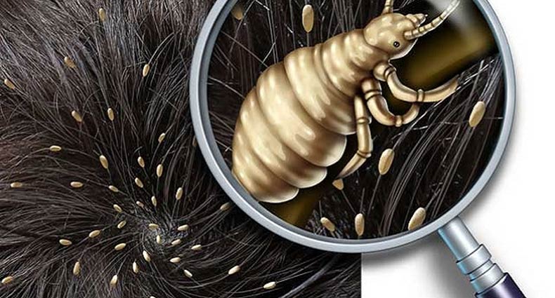 উকুন দূর করার সহজ উপায়