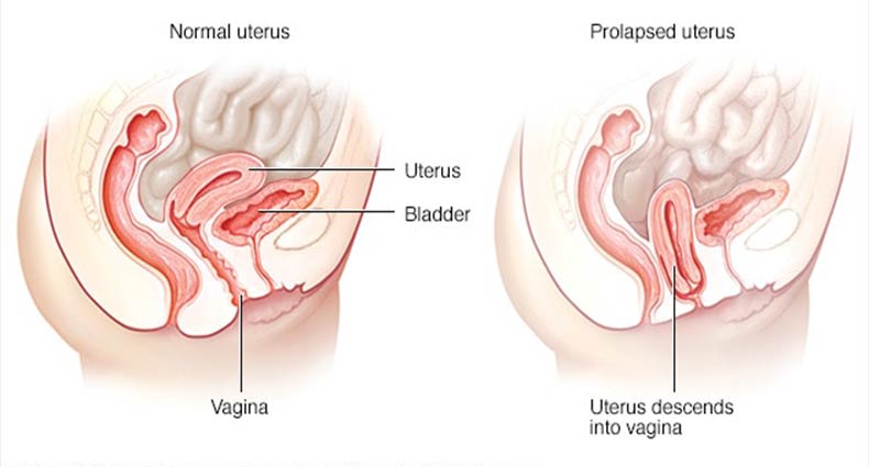 জরায়ুর স্থানচ্যুতির লক্ষণ ও করণীয়