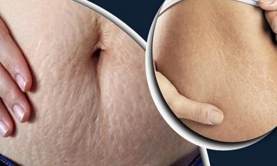 শরীরের ফাটা দাগ দূর করার উপায়