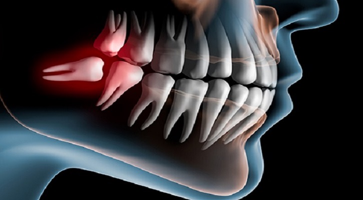 আক্কেল দাঁতের ব্যথা কমানোর উপায়