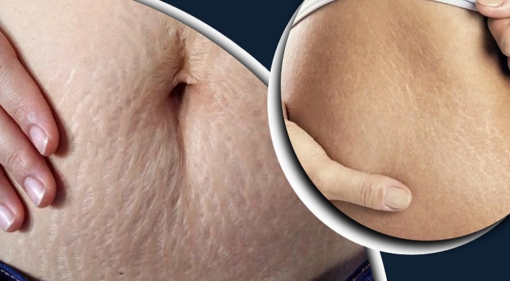 শরীরের ফাটা দাগ দূর করার উপায়