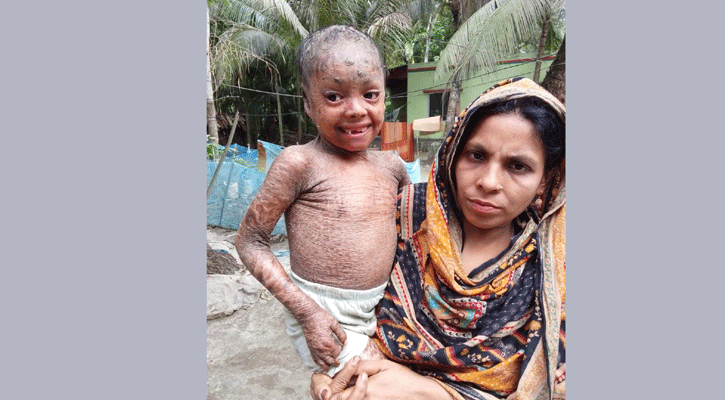 বিরল চর্মরোগে আক্রান্ত ছোট্ট তানিয়া, বাঁচাতে দরকার সবার সহানুভূতি 