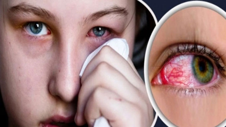 চোখ ওঠা সমস্যায় যেসব খাবার খাবেন