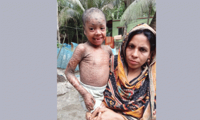 বিরল চর্মরোগে আক্রান্ত ছোট্ট তানিয়া, বাঁচাতে দরকার সবার সহানুভূতি 