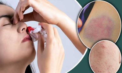 প্লাটিলেট কমতে শুরু করলে যে লক্ষণ দেখা দেয় শরীরে