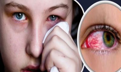চোখ ওঠা সমস্যায় যেসব খাবার খাবেন