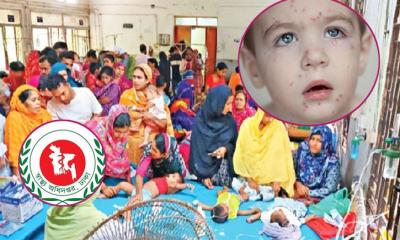 হামের উপসর্গ নিয়ে একদিনে ৯ শিশুর মৃত্যু, শনাক্ত ১১০৫