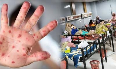 মহামারিতে রূপ নিতে পারে হাম