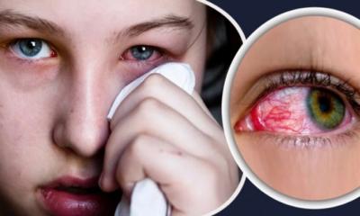 ‘চোখওঠা’ রোগ থেকে দ্রুত সুস্থ হওয়ার উপায়