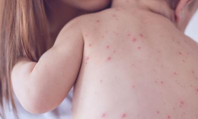 হাম: লক্ষণ, ঝুঁকি ও করণীয়