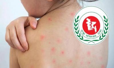 ৪ মাসে হাম ও উপসর্গে ৭৮০ মৃত্যু