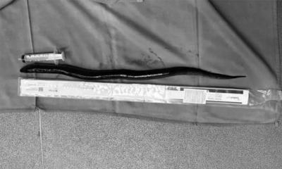 পেটে ব্যথা, অপারেশনে বেরিয়ে এলো ১২ ইঞ্চির জীবিত মাছ