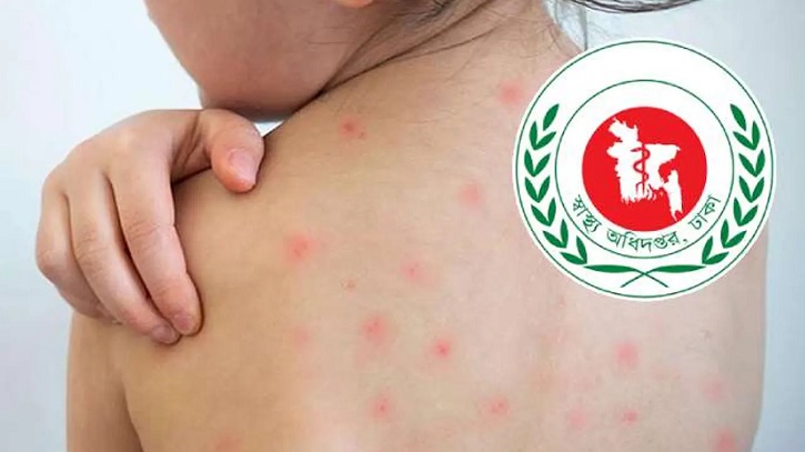 ৪ মাসে হাম ও উপসর্গে ৭৮০ মৃত্যু