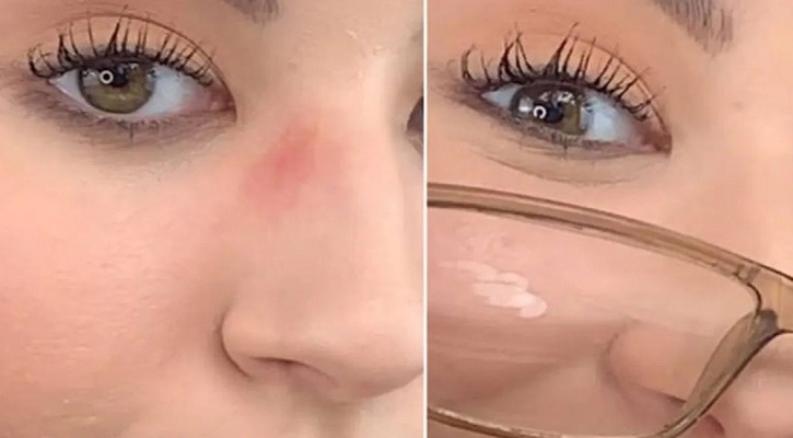 চশমা পরায় নাকের পাশে গাঢ় দাগ? দূর করুন সহজ উপায়ে