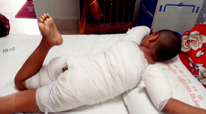 আগুনে পুড়িয়ে শিশুকে হত্যাচেষ্টা